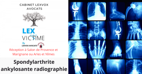 spondylarthrite-ankylosante-radiographie.png